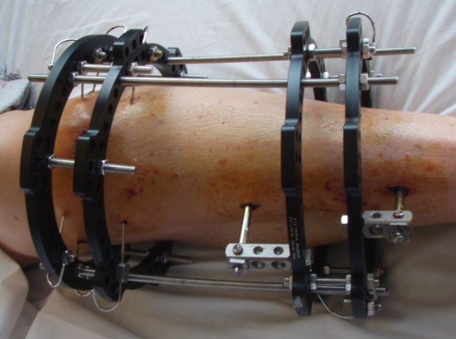 Ilizarov Frame Proximal Tibia Clinical Photo